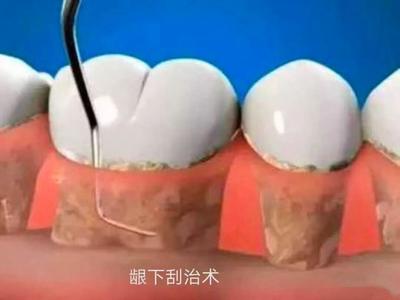 牙齿做牙周手术多少钱