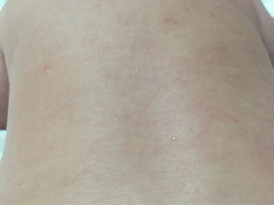 男人背上长痘痘用什么洗