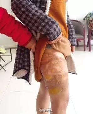 暖宝宝爆炸