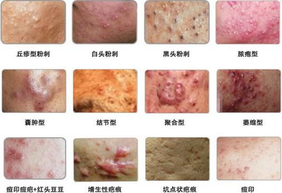 囊肿痤疮怎么治疗