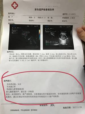 四个月可以做四维彩超吗