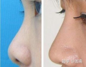 隆鼻等老了以后后遗症