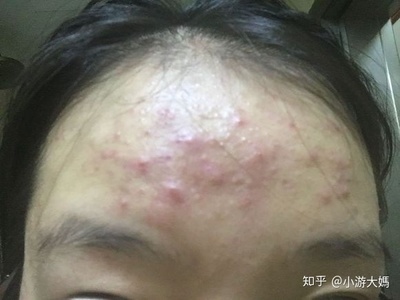 怎样去黑头痘痘