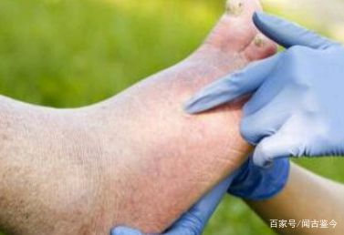 老人脚浮肿是怎么回事