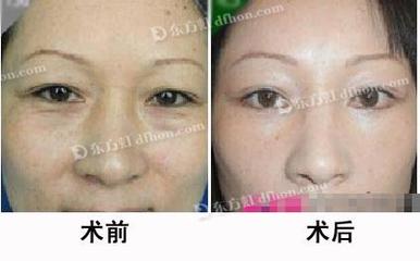 botox除皱针费用