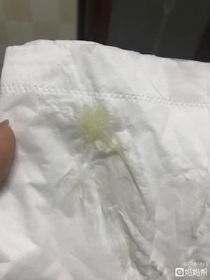 怀孕后白带多是怎么回事
