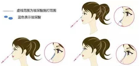 线雕隆鼻和玻尿酸区别