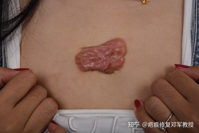 痘痘 疤痕疙瘩