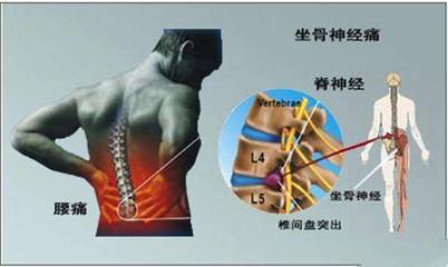 腰椎狭窄怎么治疗效果最好