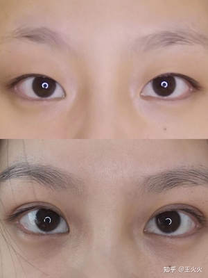隆鼻和双眼皮哪个先做