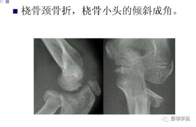骨颈骨折后几个月能好