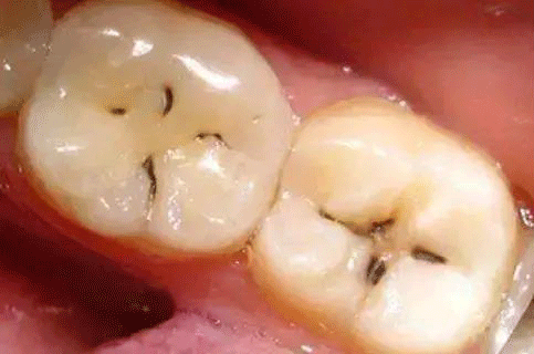 牙齿摸下感觉好臭
