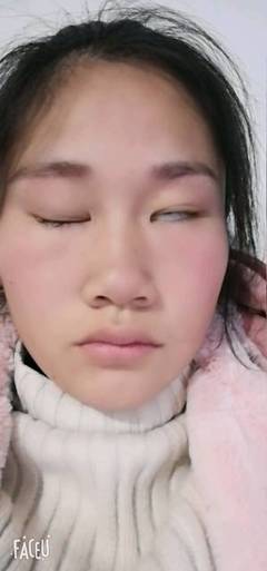 怀孕面瘫