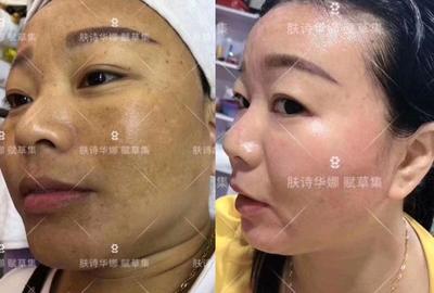 微针祛斑效果怎么样