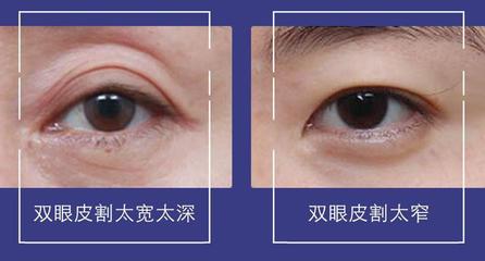 双眼皮割的太窄了