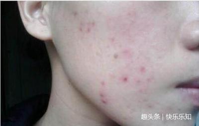 哪里有中医治痘痘