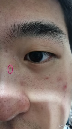 点痣后又长出来了怎么办