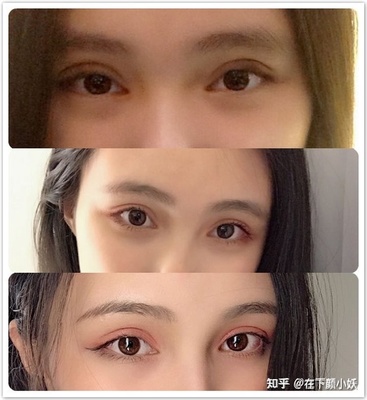 网红双眼皮