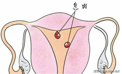 内膜息肉怎么治疗