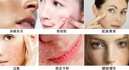 抢打痘痘