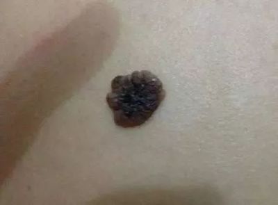 身上长痦子是怎么回事