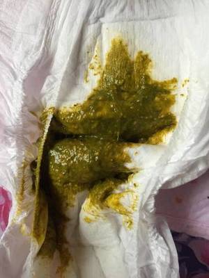 宝宝拉绿便怎么办