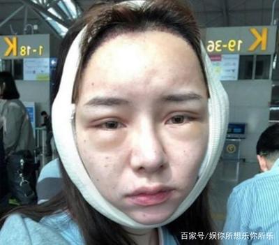 过敏脸肿了是怎么回事