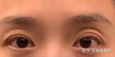 埋线双眼皮的好处