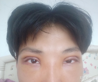 双眼皮会失败吗