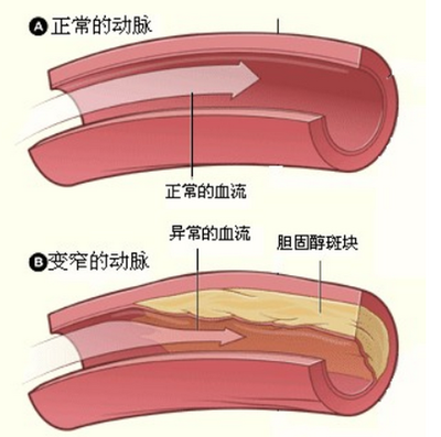 动脉闭塞怎么治疗