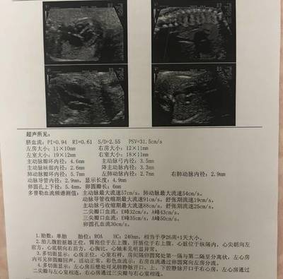 胎儿心包腔少量积液