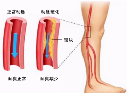 下肢动脉硬化旋切手术多少钱