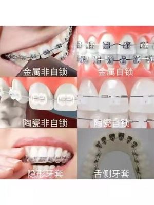 在医院带牙套好多少钱一个