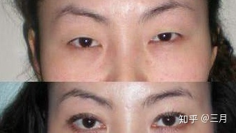 全切埋线哪个好
