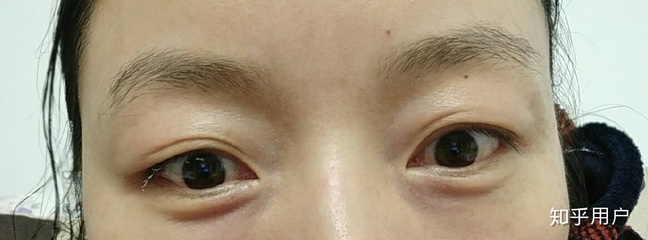 眼皮耷拉是什么病