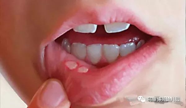 囗腔疱疹怎么治疗