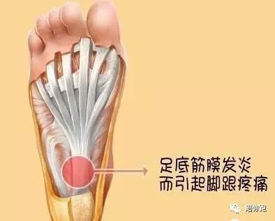 足底筋膜炎怎么治疗能除根