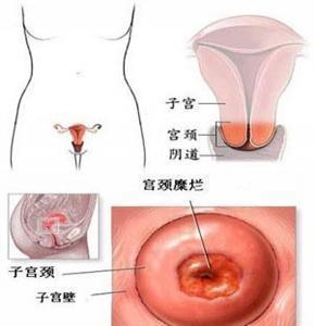 宫颈糜烂两度怎么治疗