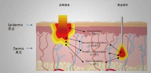 点阵后挤痘痘