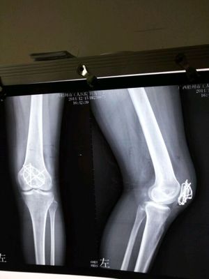 髌骨骨折是几级伤残