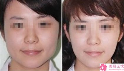 打瘦脸多久见效果明显