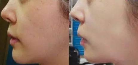 水光针后多久有效果