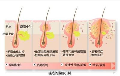 青春期头皮上有痘痘