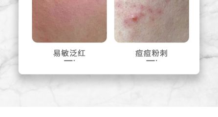 痘痘肌可以用丝瓜原液