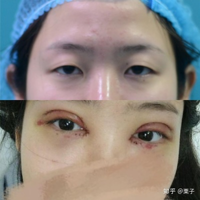 广西眼部整形