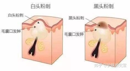 长闭口痘痘的地方变黑