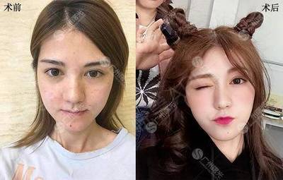 激光祛斑后可以化妆吗