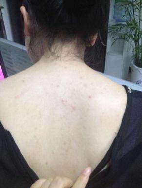 背部为什么好多痘痘