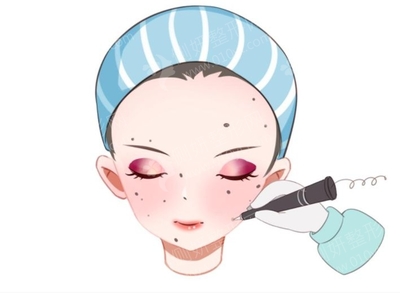 激光点痣 价格