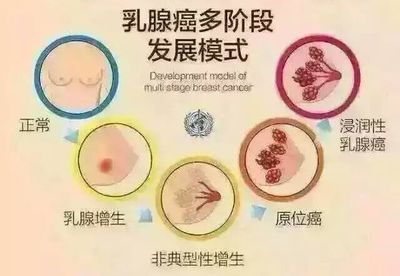 乳腺结节怎么治疗方法